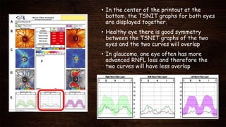• In the center of the printout at the
bottom, the TSNIT graphs for both eyes
are displayed together.
• Healthy eye there is good symmetry
between the TSNIT graphs of the two
eyes and the two curves will overlap
• In glaucoma, one eye often has more
advanced RNFL loss and therefore the
two curves will have less overlap
 