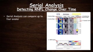 Serial Analysis
Detecting RNFL Change Over Time
• Serial Analysis can compare up to
four exams
 