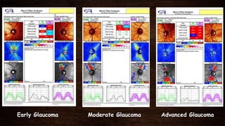 Early Glaucoma Moderate Glaucoma Advanced Glaucoma
 