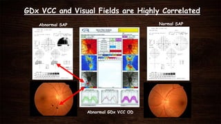 GDx VCC and Visual Fields are Highly Correlated
Abnormal SAP
Abnormal GDx VCC OD
Normal SAP
 
