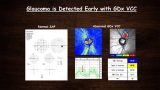 Glaucoma is Detected Early with GDx VCC
Normal SAP Abnormal GDx VCC
 