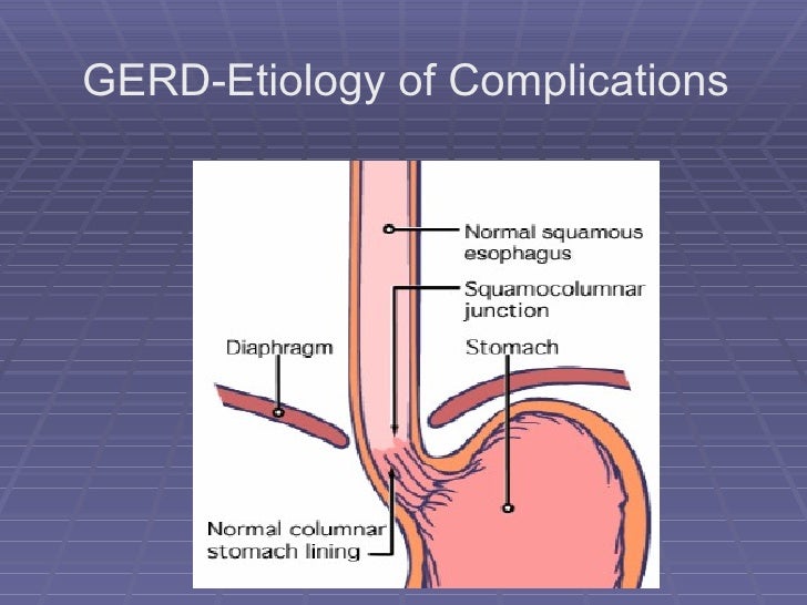 Etiology of gerd