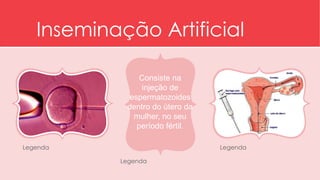 Inseminação Artificial 
Legenda Legenda 
Legenda 
Clique para adicionar 
texto 
Consiste na 
injeção de 
espermatozoides 
dentro do útero da 
mulher, no seu 
período fértil. 
 