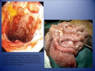  A prevalência da doença nos EUA é de 7 casos por 
100.000 indivíduos, na Europa, na África do Sul e na 
Austrália a prevalência encontra-se em torno de 0,9-3,1 
casos por 100.000 indivíduos, e na América do Sul e 
na Ásia a prevalência encontra-se em torno de 0,5-0,8 
casos por 100.000 indivíduos.

 
