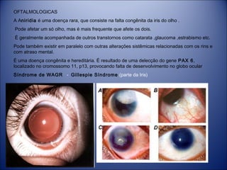 OFTALMOLOGICAS
A Aniridia é uma doença rara, que consiste na falta congênita da iris do olho .
Pode afetar um só olho, mas é mais frequente que afete os dois.
É geralmente acompanhada de outros transtornos como catarata ,glaucoma ,estrabismo etc.
Pode também existir em paralelo com outras alterações sistêmicas relacionadas com os rins e
com atraso mental.
É uma doença congênita e hereditária. É resultado de uma delecção do gene PAX 6,
localizado no cromossomo 11, p13, provocando falta de desenvolvimento no globo ocular
Síndrome de WAGR  - Gillespie Síndrome (parte da Iris)

 
