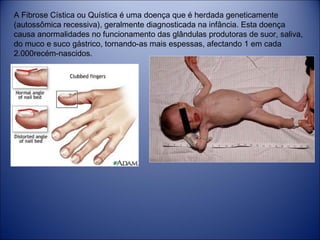 A Fibrose Cística ou Quística é uma doença que é herdada geneticamente
(autossômica recessiva), geralmente diagnosticada na infância. Esta doença
causa anormalidades no funcionamento das glândulas produtoras de suor, saliva,
do muco e suco gástrico, tornando-as mais espessas, afectando 1 em cada
2.000recém-nascidos.

 