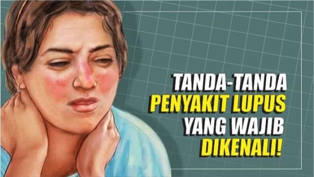 Gejala Penyakit Lupus