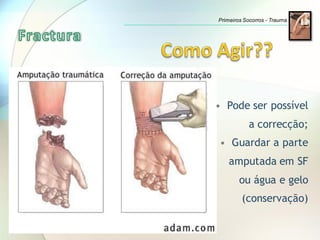 Primeiros Socorros - Trauma
• Pode ser possível
a correcção;
• Guardar a parte
amputada em SF
ou água e gelo
(conservação)
 