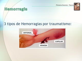 ARTERIAL
VENOSA
CAPILAR
3 tipos de Hemorragias por traumatismo:
Primeiros Socorros - Trauma
 