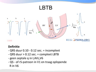 Epidemiology
•LBBB infrequent in young subjects:
 125/ 237,000 (0.5%) airmen, <30 yrs;
  90% no HD
Rotman et al, Circulati...