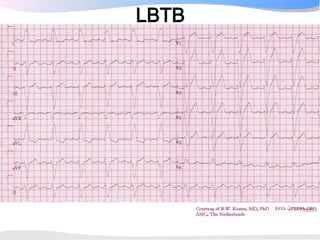 LBBB induces:
•   LV asynchronous electrical activation
•   reduced LV pump function
•   redistribution LV MBF, circ short...