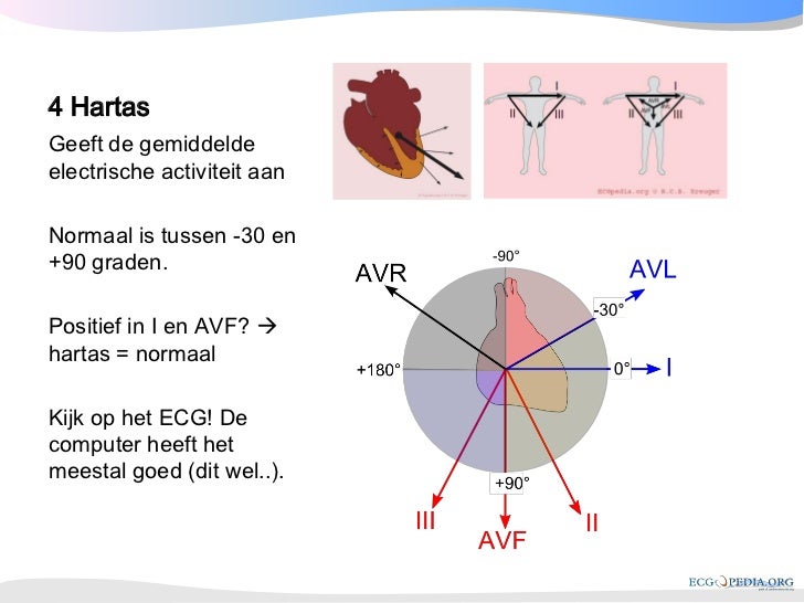 rbbb ecg