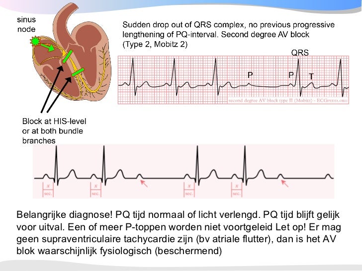 Geleidingstoornissen ECGpedia 2008