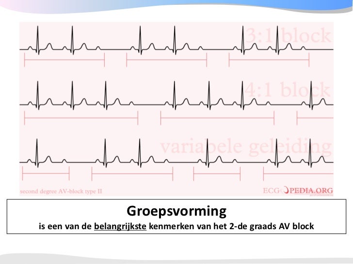 Geleidingstoornissen ECGpedia 2008