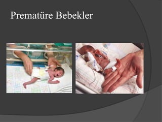 Prematüre Bebekler
 