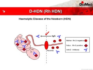 D-HDN (Rh HDN)
 