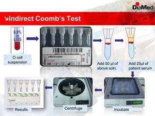 Indirect Coomb’s Test
O cell
suspension Add 50 µl of
above soln.
Results
Add 25µl of
patient serum
Centrifuge Incubate
 