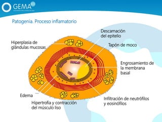 Tapón de moco
Engrosamiento de
la membrana
basal
Infiltración de neutrófilos
y eosinófilosHipertrofia y contracción
del músculo liso
Hiperplasia de
glándulas mucosas
Descamación
del epitelio
Edema
Patogenia. Proceso inflamatorio
 