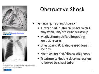 $%+<5F()*'",-.(/"
B  ?'2+3.2"=2'F6.<-.57G"
Delldot, Wikimedia Commons

Source:
www.meddean.luc.edu/lumenMedEd/medicine/
pulmonar/cxr/pneumo1.htm

B  e35"<57=='D"32"=8'F578"+=7('"I3<-"!"
I7:"*78*'R"735f=5'++F5'"%F38D+"F="
B  ^'D37+)2F6"+-3n'D"36='D32;"
*'2.F+"5'<F52"
B  >-'+<"=732R",$KR"D'(5'7+'D"%5'7<-"
+.F2D+"
B  4."<'+<+"2''D'Df(8323(78"D37;2.+3+"
B  ?5'7<6'2<b"4''D8'"D'(.6=5'++3.2"
@.88.I'D"%:"(-'+<"<F%'"
P#"

 