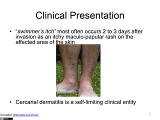 Clinical Presentation
•  “swimmer’s itch” most often occurs 2 to 3 days after
invasion as an itchy maculo-papular rash on the
affected area of the skin

•  Cercarial dermatitis is a self-limiting clinical entity
Cornellier, Wikimedia Commons

7

 