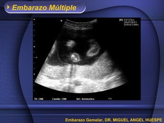 Embarazo Múltiple
Embarazo Gemelar, DR. MIGUEL ANGEL HUESPE
 