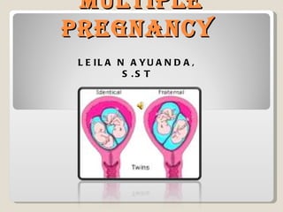 MULTIPLE
PREGNANCY
L E IL A N A YU A N D A ,
          S .S T
 