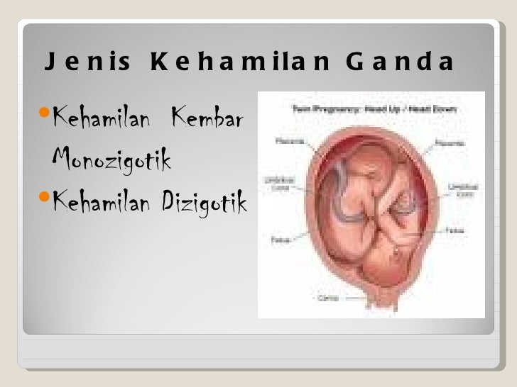 Kehamilan Kembar