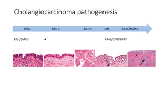Cholangiocarcinoma pathogenesis
BilN1 BILN 2 BILN 3 CIN CARCINOMA
P53 /SMAD  KRAS/EGFR/BRAF
 