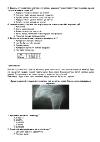 3. Шууны хугарамтгай хэсгийн хугарлын үед гөлтгөнөн боолтуудыг хаанаас хаана
хүртэл хэмжиж тавих вэ?
1. Хурууны үзүүрээс тохойн үе хүртэл
2. Хурууны угийн үенээс мөрний үе хүртэл
3. Бугуйн үенээс атгаалын доод 1/3 хүртэл
4. Хурууны угийн үенээс тохойн үе хүртэл
5. Бугуйн үенээс мөрний үе хүртэл
4. Чөмөгт ясны хугарлын үед илрэх үндсэн шинж тэмдгийг нэрлэнэ үү?
1. Хавантай
2. Эмгэг хөдөлгөөнтэй
3. Ясны хавиралдах чимээтэй
4. Үений тогоо, чөмөгний толгой тусдаа тэмтрэгдэнэ
5. Пүрштэй юм шиг эсэргүүцэлтэй
5. Татлагын ачааны хэмжээ юунаас хамаарах вэ?
1. Хугарснаас хойших хугацаа
2. Нас ба булчингийн хөгжил
3. Биеийн онцлог
4. Хугарлын зөрөөний хэлбэр байрлал
5. Гэмтлийн механизм
№ 1 2 3 4 5
Хариу E C D A C
Тохиолдол 4
Өвчтөн Ц 75 настай Эрэгтэй хальтарч унаж гэмтсэнээс гишгэж явж чадахгүй. Үзэхэд: Зүүн
гуя хавантай, хөлийн тавхай гадагш эргэн бага зэрэг богиносолттой, өсгий наалдах шинж
илрэнэ. Зүүн талын өгзөг ташаа орчмоор хөхөрсөн эмзэглэлтэй,
Рентгенд: Зүүн талын дунд чөмөгний хүзүү хөндлөн хугарсан, зөрсөн.
Дунд чөмөгний хүзүүний хугаралын үед рентгэн зураг болон эмнэл зүйд гарах
өөрчлөлт
1. Урьдчилсан онош тавина уу?
А. С32В13
В. С31А3
С. С42 В21
D. С31 В3
Е. С22 В13
2. Яаралтай хийх шинжилгээг нэрлэнэ үү?
1. Шээсний ерөнхий шинжилгээ
2. Рентген зураг
 