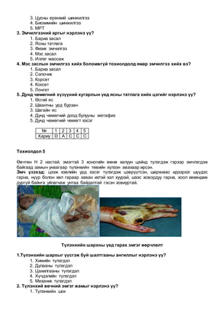 3. Цусны ерөнхий шинжилгээ
4. Биохимийн шинжилгээ
5. МРТ
3. Эмчилгээний аргыг нэрлэнэ үү?
1. Бариа засал
2. Ясны татлага
3. Физик эмчилгээ
4. Мэс засал
5. Иллэг массаж
4. Мэс заслын эмчилгээ хийх боломжгүй тохиолдолд ямар эмчилгээ хийх вэ?
1. Бариа засал
2. Сапочик
3. Корсет
4. Коксет
5. Лонгет
5. Дунд чөмөгний хүзүүний хугарлын үед ясны татлага хийх цэгийг нэрлэнэ үү?
1. Өсгий яс
2. Шаантны урд бурзан
3. Шагайн яс
4. Дунд чөмөгний доод булууны метафиз
5. Дунд чөмөгний чөмөгт хэсэг
№ 1 2 3 4 5
Хариу D A C C C
Тохиолдол 5
Өвчтөн Н 2 настай, эмэгтэй 3 хоногийн өмнө халуун цайнд түлэгдэж гэрээр эмчлэгдэж
байгаад замын унаагаар түлэнхийн төвийн хүлээн авахаар ирсэн.
Эмч үзэхэд: цээж хэвлийн урд хэсэг түлэгдэж цэврүүтсэн, шархнаас идээрхэг шүүдэс
гарна, нүүр болон хөл гараар хаван ихтэй хэл хуурай, шээс ховордуу гарна, хоол хөхөндөө
дургүй байнга уйлагнаж унтаа байдалтай гэсэн зовиуртай.
Түлэнхийн шархны үед гарах эмгэг өөрчлөлт
1.Түлэнхийн шархыг үүсгэж буй шалтгааны ангиллыг нэрлэнэ үү?
1. Химийн түлэгдэл
2. Дулааны түлэгдэл
3. Цахилгааны түлэгдэл
4. Хүчдэлийн түлэгдэл
5. Механик түлэгдэл
2. Түлэнхий өвчний эмгэг жамыг нэрлэнэ үү?
1. Түлэнхийн шок
 