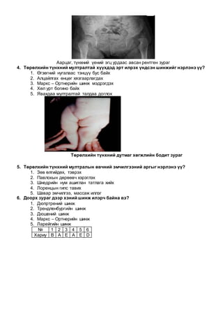Аарцаг, түнхний үений эгц урдаас авсан рентген зураг
4. Төрөлхийн түнхний мултралтай хүүхдэд эрт илрэх үндсэн шинжийг нэрлэнэ үү?
1. Өгзөгний нугалаас тэнцүү бус байх
2. Алцайлгах өнцөг хязгаарлагдах
3. Маркс – Ортнерийн шинж мэдрэгдэх
4. Хөл урт богино байх
5. Явахдаа мултралтай талдаа доглох
Төрөлхийн түнхний дутмаг хөгжлийн бодит зураг
5. Төрөлхийн түнхний мултралын өвчний эмчилгээний аргыг нэрлэнэ үү?
1. Зөв өлгийдөх, тэврэх
2. Павлокын дөрөөвч хэрэглэх
3. Шнедрийн нум ашиглан татлага хийх
4. Лоренцын гипс тавих
5. Шавар эмчилгээ, массаж иллэг
6. Доорх зураг дээр хэний шинж илэрч байна вэ?
1. Дюпртрений шинж
2. Трендленбургийн шинж
3. Дюшений шинж
4. Маркс – Ортнерийн шинж
5. Ларейгийн шинж
№ 1 2 3 4 5 6
Хариу B A E A E D
 