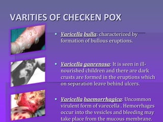 VARITIES OF CHECKEN POX
 Varicella bulla: characterized by
formation of bullous eruptions.
 Varicella ganrenosa: It is seen in ill-
nourished children and there are dark
crusts are formed in the eruptions which
on separation leave behind ulcers.
 Varicella haemorrhagica: Uncommon
virulent form of varecella . Hemorrhages
occur into the vesicles and bleeding may
take place from the mucous membrane.
 