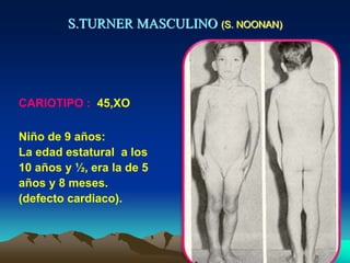 S.TURNER MASCULINO (S. NOONAN)
Niño de 9 años:
La edad estatural a los
10 años y ½, era la de 5
años y 8 meses.
(defecto cardiaco).
CARIOTIPO : 45,XO
 
