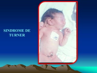 SINDROME DE
TURNER
 