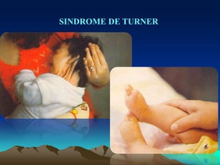SINDROME DE TURNER
 