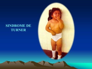 SINDROME DE
TURNER
 