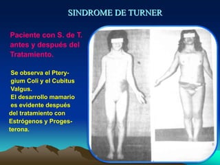 SINDROME DE TURNER
Paciente con S. de T.
antes y después del
Tratamiento.
Se observa el Ptery-
gium Coli y el Cubitus
Valgus.
El desarrollo mamario
es evidente después
del tratamiento con
Estrógenos y Proges-
terona.
 
