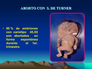 ABORTO CON S. DE TURNER
• 90 % de embriones
con cariotipo 45,X0
son abortados en
forma espontánea
durante el 1er.
trimestre.
 