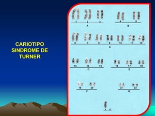 CARIOTIPO
SINDROME DE
TURNER
 