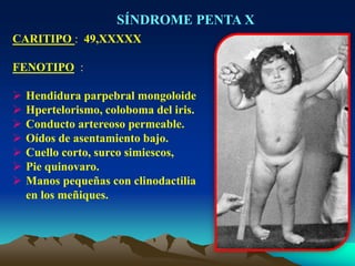 SÍNDROME PENTA X
CARITIPO : 49,XXXXX
FENOTIPO :
 Hendidura parpebral mongoloide
 Hpertelorismo, coloboma del iris.
 Conducto artereoso permeable.
 Oídos de asentamiento bajo.
 Cuello corto, surco simiescos,
 Pie quinovaro.
 Manos pequeñas con clinodactilia
en los meñiques.
 