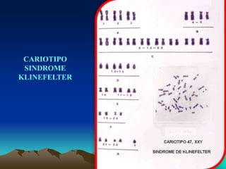 CARIOTIPO
SINDROME
KLINEFELTER
 