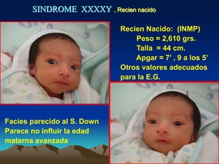 SINDROME XXXXY , Recien nacido
Recien Nacido: (INMP)
Peso = 2,610 grs.
Talla = 44 cm.
Apgar = 7’ , 9 a los 5’
Otros valores adecuados
para la E.G.
Facies parecido al S. Down
Parece no influir la edad
materna avanzada
 