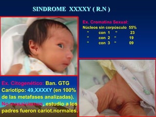 SINDROME XXXXY ( R.N )
Ex. Cromatina Sexual:
Núcleos sin corpúsculo 55%
“ con 1 “ 23
“ con 2 “ 19
“ con 3 “ 09
Ex. Citogenético: Ban. GTG
Cariotipo: 49,XXXXY (en 100%
de las metafases analizadas).
No mosaicismos, estudio a los
padres fueron cariot.normales.
 