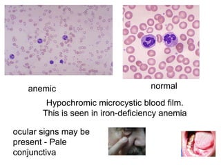 anemic normal
Hypochromic microcystic blood film.
This is seen in iron-deficiency anemia
ocular signs may be
present - Pale
conjunctiva
 