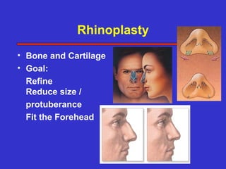 Rhinoplasty
• Bone and Cartilage
• Goal:
  Refine
  Reduce size /
  protuberance
  Fit the Forehead
 