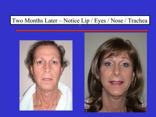 Two Months Later – Notice Lip / Eyes / Nose / Trachea
 