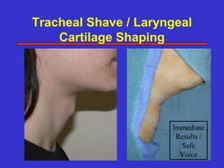 Tracheal Shave / Laryngeal
    Cartilage Shaping




                      Immediate
                       Results /
                        Safe
                        Voice
 