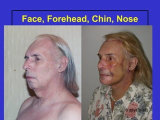 Face, Forehead, Chin, Nose




                       6 days later
 