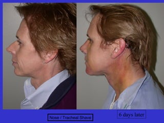 Nose / Tracheal Shave
                        6 days later
 