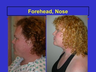 Forehead, Nose
 